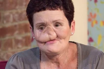 Ung thư mặt hủy hoại dung nhan khủng khiếp thế nào?