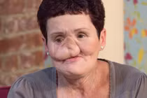 Ung thư mặt hủy hoại dung nhan khủng khiếp thế nào?