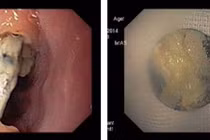 Bác sĩ hết hồn gắp cục pin rỉ trong thực quản cháu bé