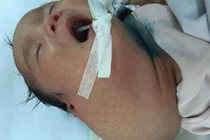 Thai nhi mắc kẹt ở vùng kín của mẹ vì khối u khổng lồ