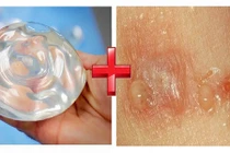 Miếng dán silicon: đẹp vòng 1 và đầy ẩn hoạ chết người