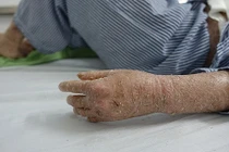 Khổ sở kinh hoàng căn bệnh “người rắn” ở Việt Nam