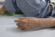 Khổ sở kinh hoàng căn bệnh “người rắn” ở Việt Nam