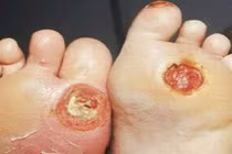 Bệnh tiểu đường - Thủ phạm khiến nhiều người cụt chân tay trong 1 tuần