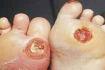 Bệnh tiểu đường - Thủ phạm khiến nhiều người cụt chân tay trong 1 tuần