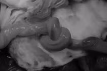 Bé trai chào đời với vòng dây rốn thắt nút cực hiếm