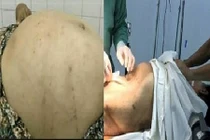 Tưởng béo bụng, đi khám mới phát hiện khối u gần 20kg