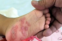 Cảnh báo bệnh tay chân miệng bùng phát mùa khai trường