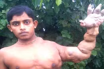 20 năm sống trong sợ hãi vì cơ thể biến dạng do mắc bệnh hiếm