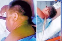 Bình tĩnh vào bệnh viện với thanh gỗ 38cm xuyên qua mặt