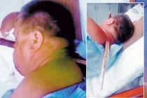 Bình tĩnh vào bệnh viện với thanh gỗ 38cm xuyên qua mặt