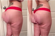 Hãi hùng vòng 3 phẫu thuật thẩm mỹ hỏng