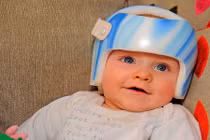 Bé trai khỏi chứng đầu phẳng nhờ mũ bảo hiểm chuyên dụng