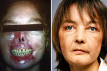 Những ca ghép mặt nổi tiếng nhất lịch sử y học