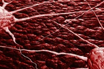 Sự tàn phá khủng khiếp của ung thư cổ tử cung