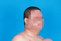 Nổi khối u khổng lồ trên ngực sau khi bị điện giật