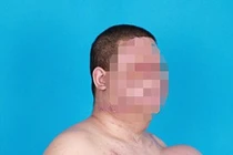 Nổi khối u khổng lồ trên ngực sau khi bị điện giật