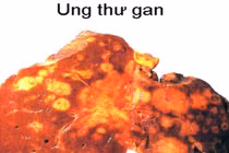 Tiết lộ các dạng ung thư dễ tấn công người giàu