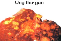 Tiết lộ các dạng ung thư dễ tấn công người giàu