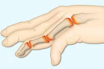 Lời khuyên để sống cùng bệnh viêm khớp vảy nến