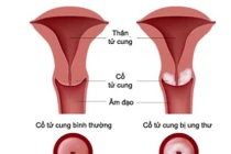 Tận dụng thảo dược trị ung thư cổ tử cung hiệu quả