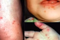 7 bệnh nguy hiểm ai cũng có thể mắc trong mùa hè