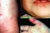 7 bệnh nguy hiểm ai cũng có thể mắc trong mùa hè