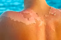 Mẹo hay cứu làn da cháy nắng