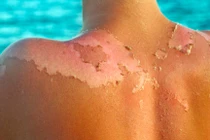 Mẹo hay cứu làn da cháy nắng