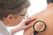 Những đối tượng dễ mắc ung thư da