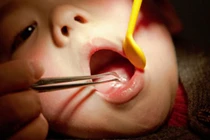 Dây chuyền thánh giá rơi vào họng, bé gái đi cấp cứu