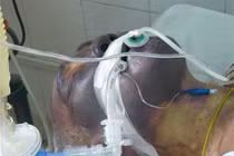 Hình ảnh khủng khiếp về tác hại của món tiết canh