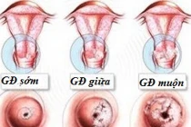 Hai chiêu đơn giản đánh bại ung thư cổ tử cung