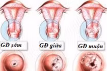 Hai chiêu đơn giản đánh bại ung thư cổ tử cung