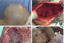 Ám ảnh ca phẫu thuật u nang buồng trứng nặng 40kg