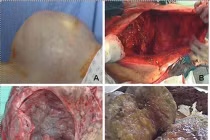 Ám ảnh ca phẫu thuật u nang buồng trứng nặng 40kg