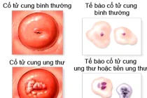 9 sự thật giật mình về ung thư cổ tử cung