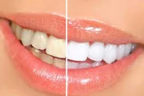 100 triệu vi khuẩn trú ngụ trong bàn chải đánh răng