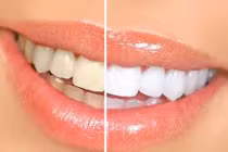 100 triệu vi khuẩn trú ngụ trong bàn chải đánh răng