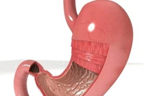 Phân biệt ung thư dạ dày với viêm loét thông thường