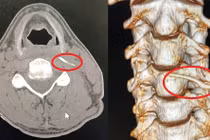 Uống "nước thần" chữa hóc xương, người đàn ông nhập viện khẩn cấp