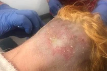 Tự tẩy tóc tại nhà, cô gái rước họa vào thân, lóc cả mảng da đầu