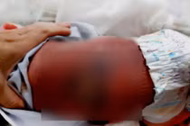 Bé sơ sinh bị bỏng nặng, nhiễm trùng máu do sưởi than