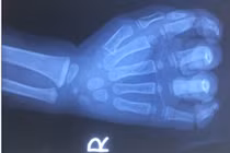 Bé trai 23 tháng tuổi nát cả bàn tay do bị cuốn vào dây coroa máy rửa xe