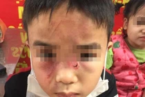 Nghi vấn bé trai bị bố đánh sước mặt tím lưng vì ăn trộm tiền