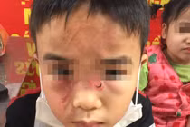 Nghi vấn bé trai bị bố đánh sước mặt tím lưng vì ăn trộm tiền