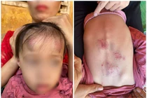 Bé gái 2 tuổi bị bạn học đánh, đạp dã man ở Bắc Giang
