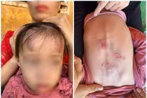 Bé gái 2 tuổi bị bạn học đánh, đạp dã man ở Bắc Giang