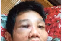 Mâu thuẫn tại chốt kiểm dịch, một cán bộ bị đánh nhập viện