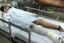 Bé gái bị mẹ đốt ở Bình Thuận quằn quại chống tử thần